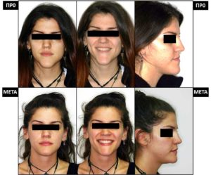 Δυσαρμονίες Προσώπου – Ορθογναθική Χειρουργική