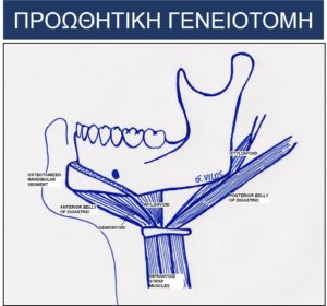 προωθητική γενειοτομή
