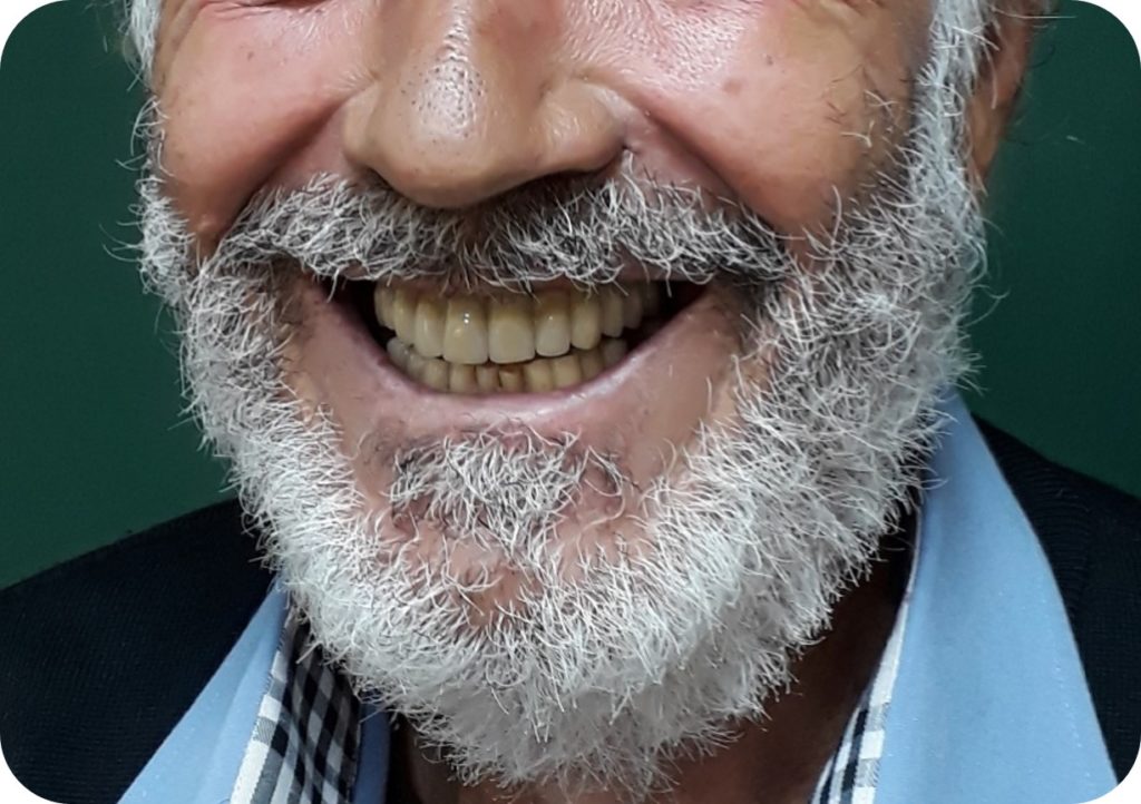 Οδοντικά Εμφυτεύματα Οδοντικά Εμφυτεύματα